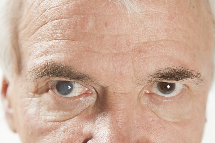 катаракта глаза у пожилых